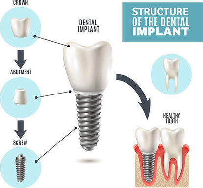 dental-implant-structure.jpg