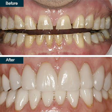 Before-After-Press-On-Dental-Veneers-Bronx-NYC.jpg